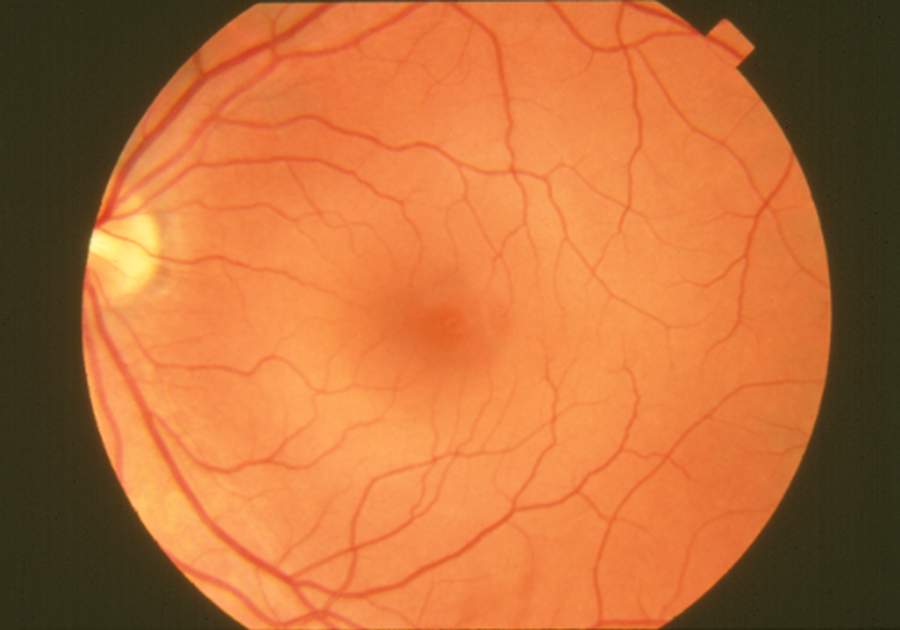 Fundus photograph normal retina EDA06